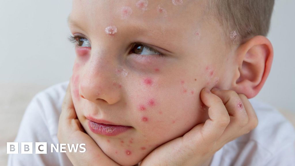 What is chickenpox and who can get the NHS vaccine?