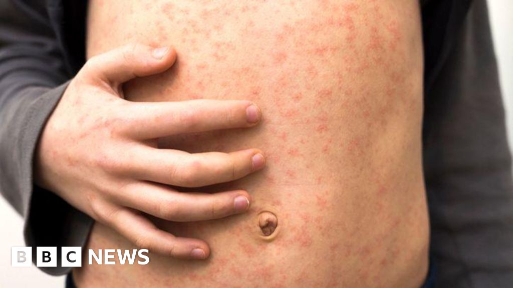 North London measles outbreak hits several schools with at least 34 children infected