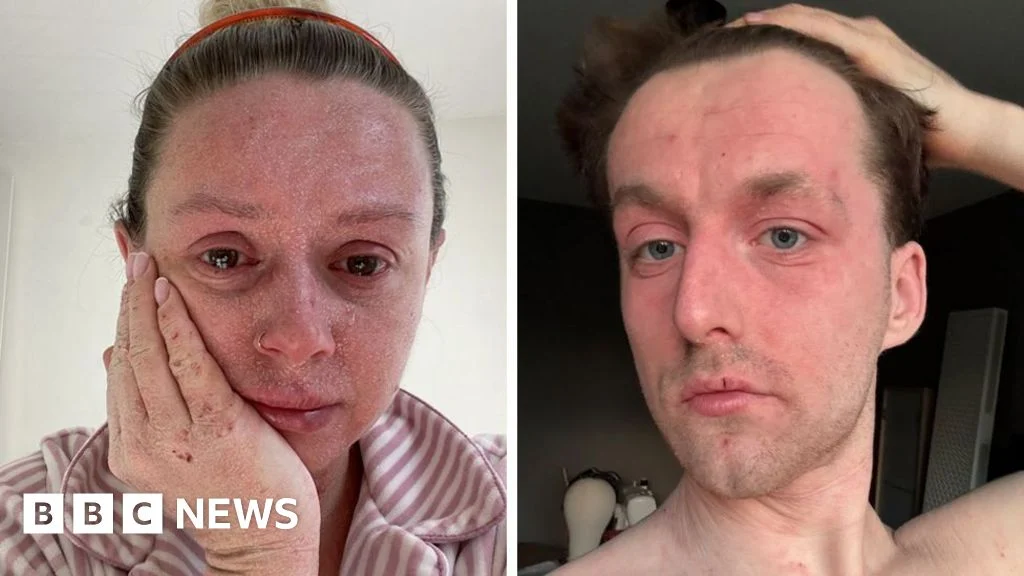 Life with TSW: ‘Our skin is falling off and no-one can tell us why’