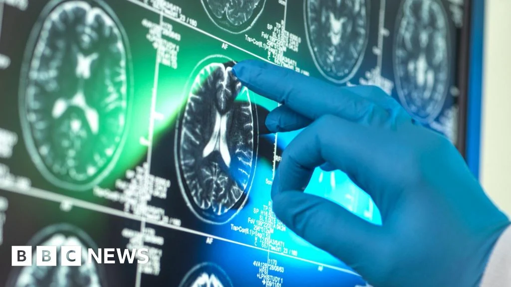 ‘Breakthrough’ Alzheimer’s drugs unlikely to benefit patients, report suggests