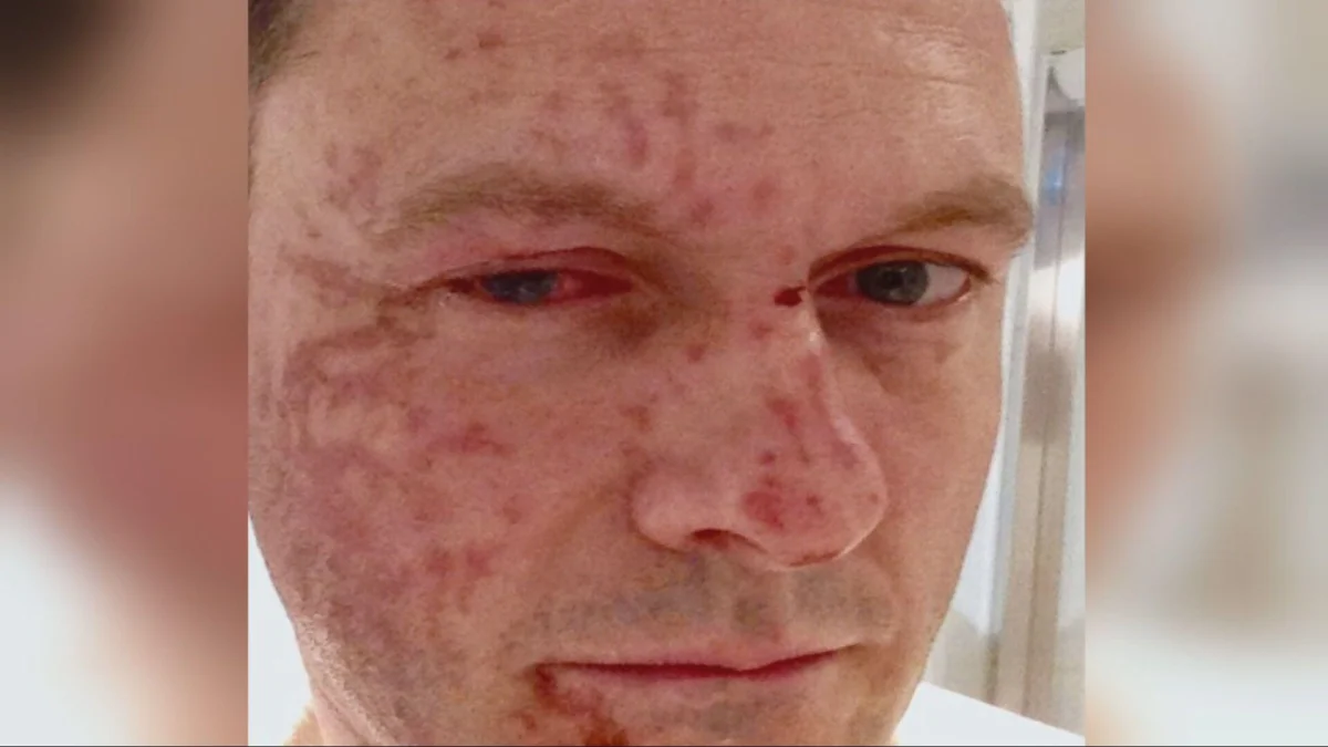 Gangland hitman who threw acid at Scottish Conservative leader Russell Findlay is freed